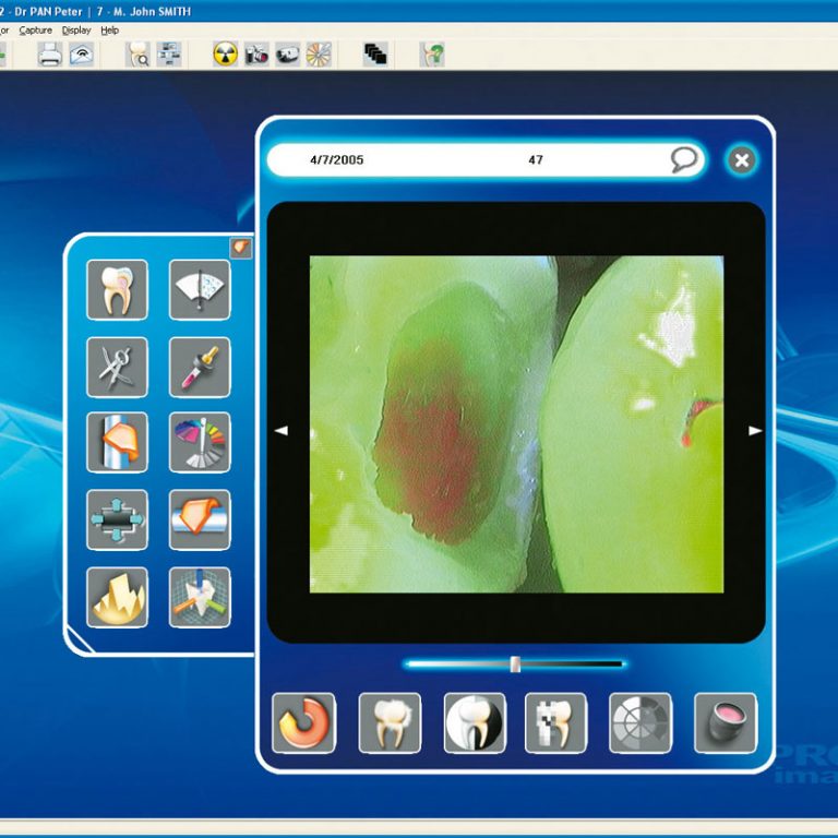 Acteon Sopro 617 - Intra-oral Camera - presidental